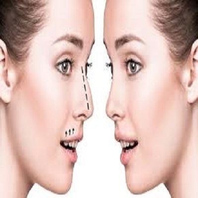 Rhinoplasty
