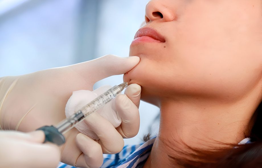 jawline filler injections